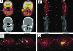 Excellent Response With Alpelisib and Bicalutamide for Advanced Salivary Duct Carcinoma With PIK3CA Mutation and High Androgen Receptor Expression-A Case Report