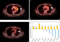 Adaptive, Iterative, Long-Term Personalized Therapy Management in a Case of Stage IV Refractory NSCLC