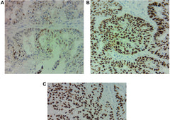 A case report of androgen receptor inhibitor therapy in recurrent high-grade serous ovarian cancer