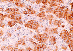 Accurate Screening for Early-Stage Breast Cancer by Detection and Profiling of Circulating Tumor Cells