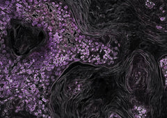 Improved Treatment Outcomes by Using Patient Specific Drug Combinations in Mammalian Target of Rapamycin Activated Advanced Metastatic Cancers
